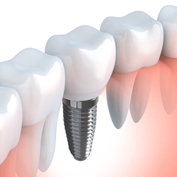 Tooth Replacement
